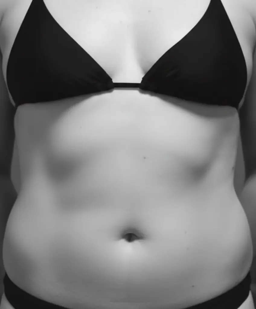 Redução Abdominal Antes