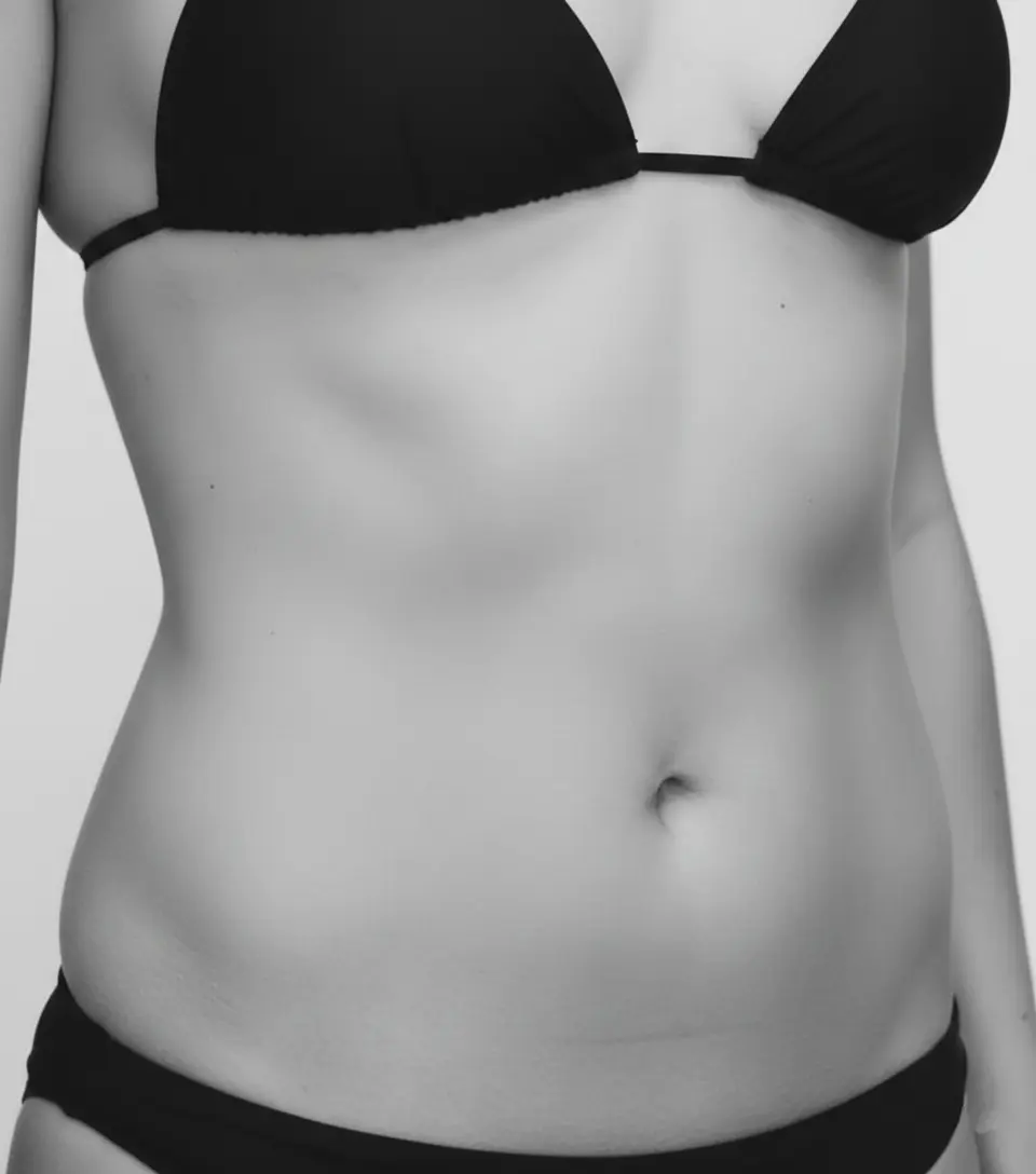 Redução Abdominal Depois